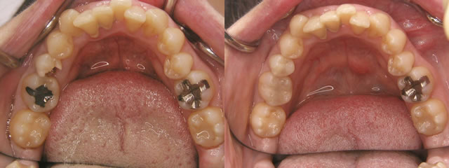 歯科　術前・術後　症例（A-1）
