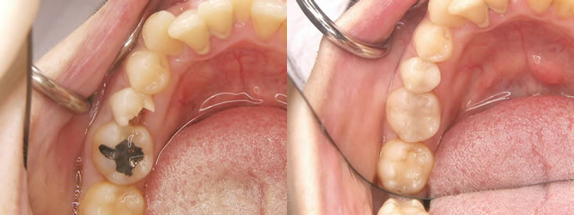 歯科　術前・術後　症例（A-2）