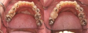 歯科　術前・術後　症例（B）