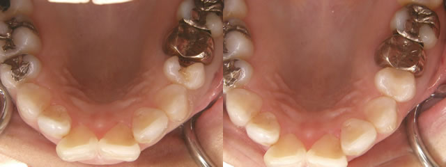 歯科　術前・術後　症例（C）