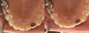 歯科　術前・術後　症例（D-2）