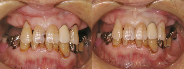 歯科　術前・術後　症例（E-1）