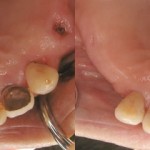 歯科　術前・術後　症例（E-2）