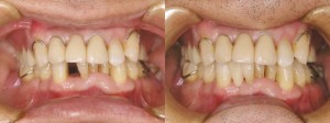 歯科　術前・術後　症例（G）